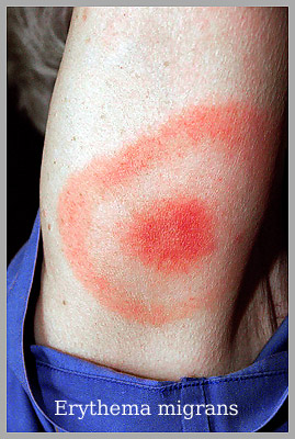 Erythema Amstelveen