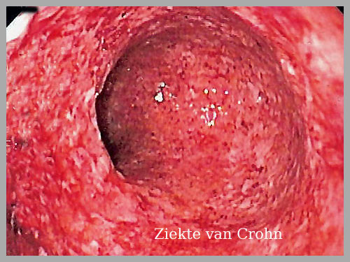 Crohn Amstelveen